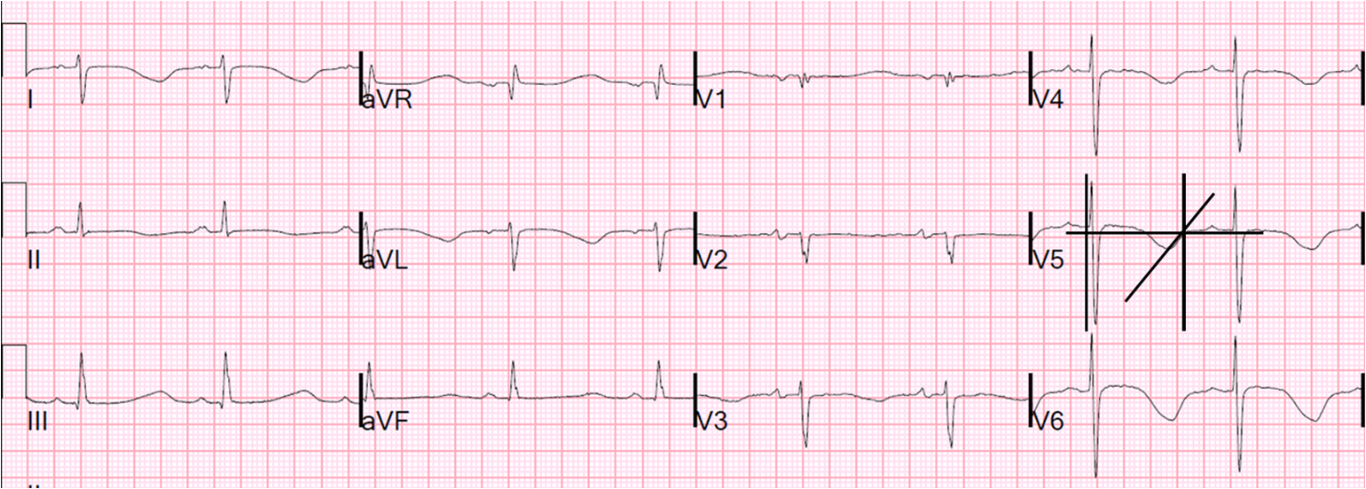 Dr. Smith's ECG Blog Long QT Do not trust the computerized QT