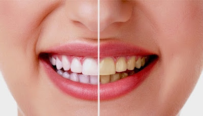 Cara Memutihkan Gigi Secara Cepat dan Mudah