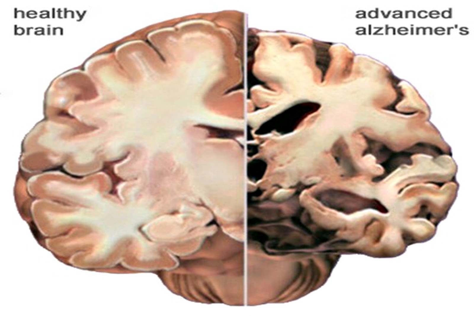 Степени атрофия мозга. Атрофические изменения коры головного мозга. Отмирание клеток головного мозга симптомы. Атрофия коры головного мозга симптомы. Отмирание коры головного мозга.
