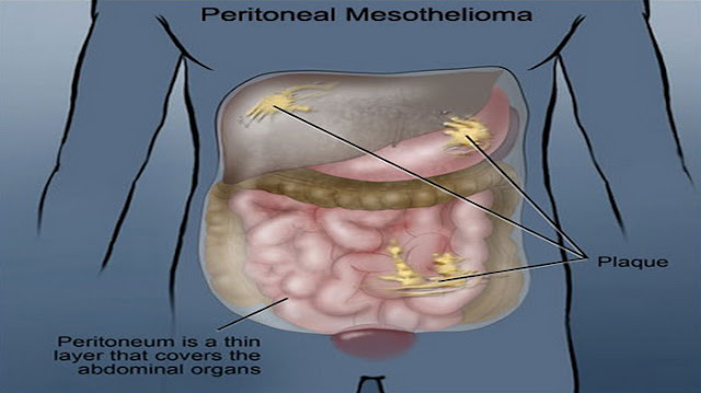 Demystifying Mesothelioma and Creating Solutions
