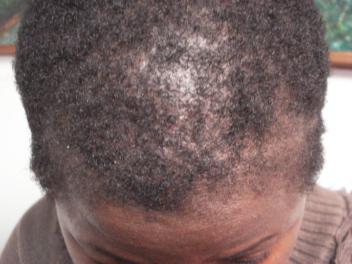Central centrifugal cicatricial alopecia - UpToDate