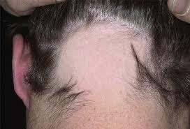 Alopecia universala
