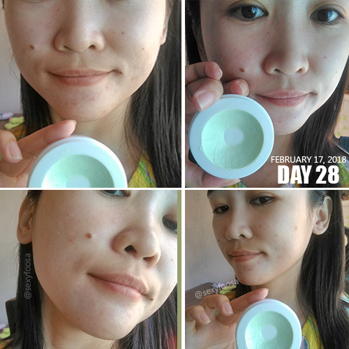 Goree Cream and Soap Review Can It Effectively Vanish Your Acne and