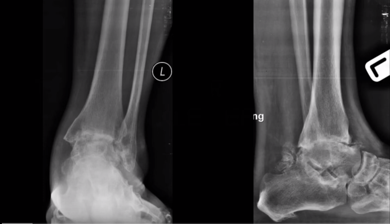 โรคเท้าและข้อเท้า ข้อเท้าเสื่อม (Ankle arthritis)