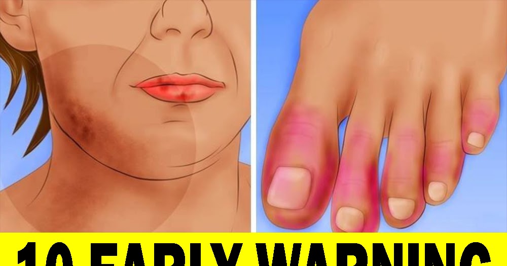 Here Are 10 Early Warning Signs Of Lupus You Need To Know!!!