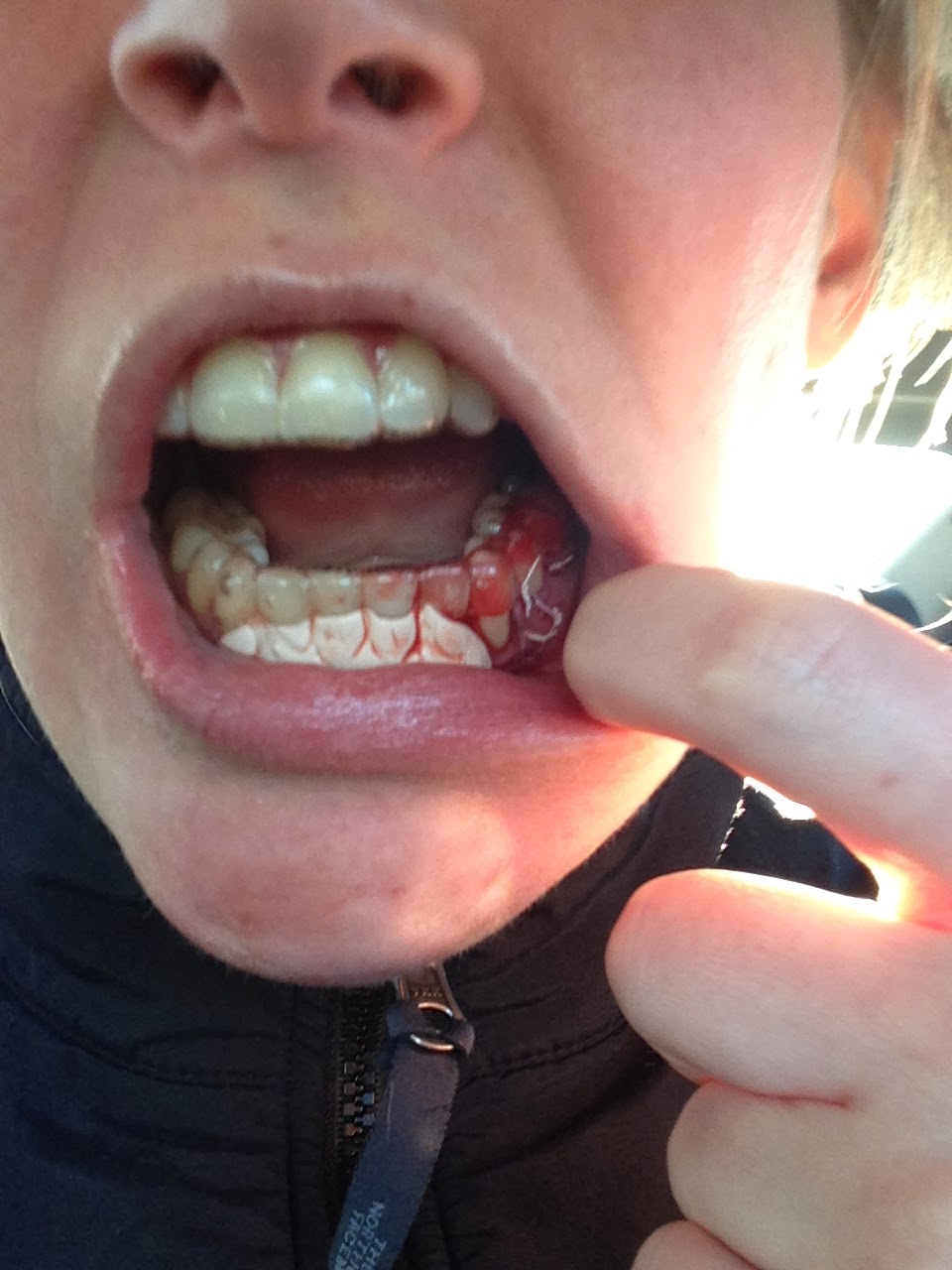 A smile is a curve that sets everything straight. ) [My Jaw Surgery