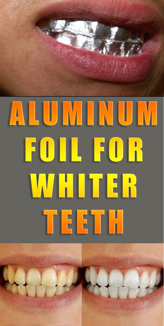 Aluminum foil for whiter teeth HEALTH ROOTS