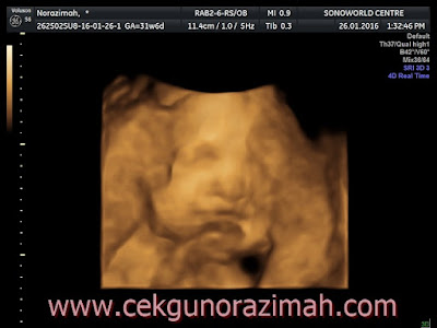 3d4d scan ultrasound, sonoworld centre, scan 3d4d