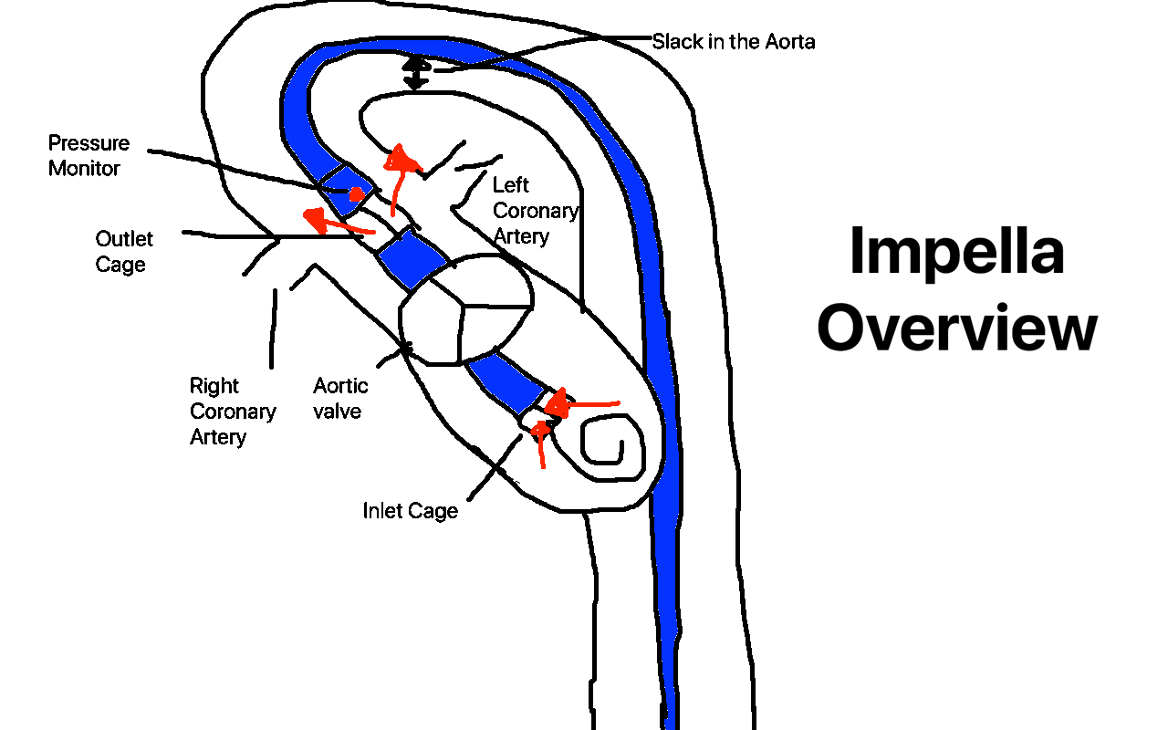 Impella Basics for Caregivers