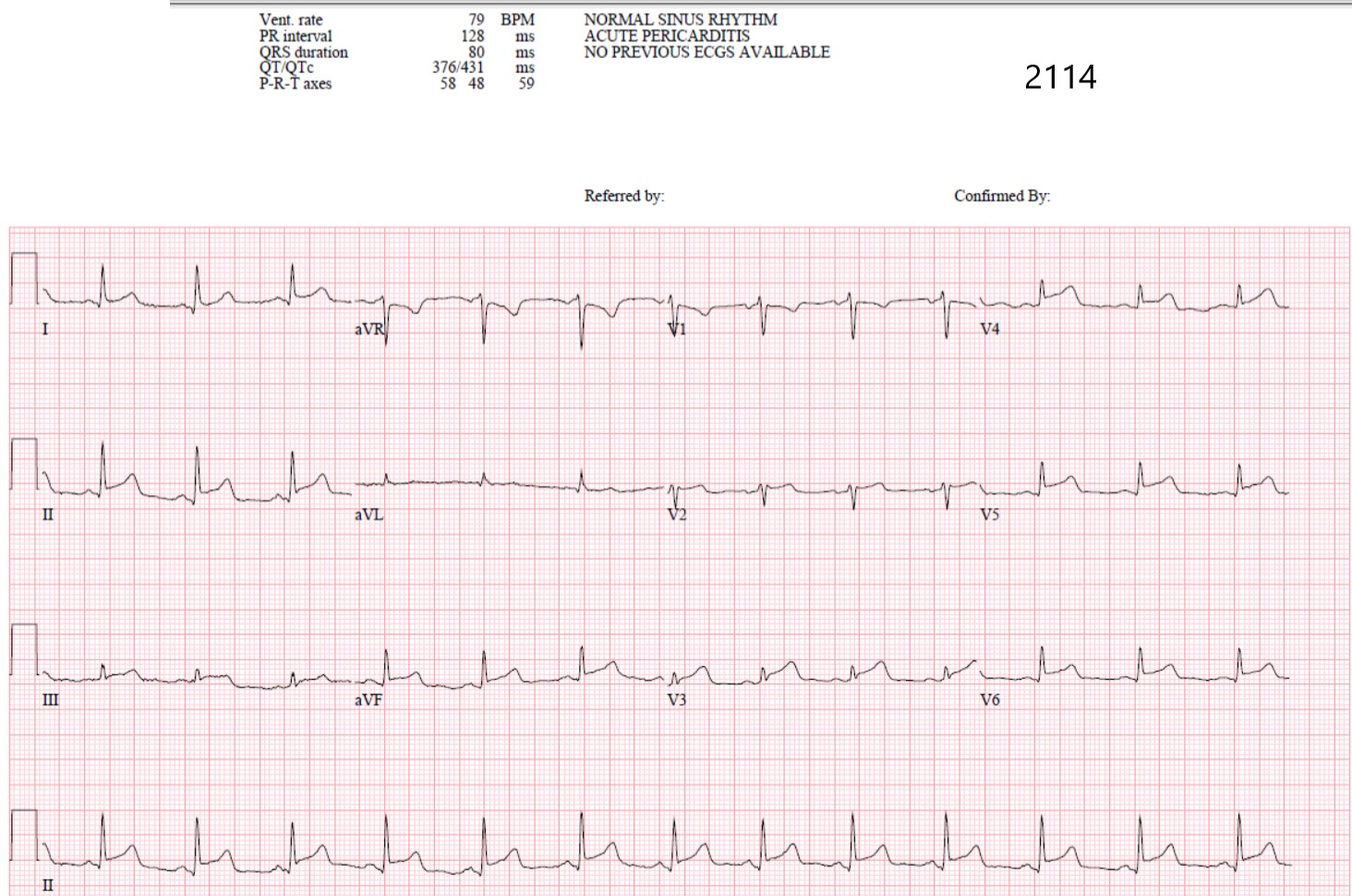 Dr. Smith's ECG Blog: You Diagnose Pericarditis at your Peril (at the