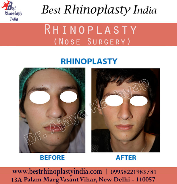 Best Rhinoplasty India Factors that Influence Nose Surgery Cost
