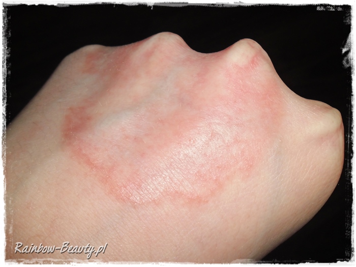 Czerwone Plamy Na Dloniach Popekana I Piekaca Skora Uczulenie Na Zimno Rainbow Beauty Blog
