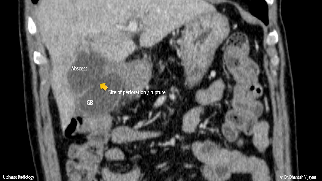 Ultimate Radiology Acute Cholecystitis with intrahepatic perforation