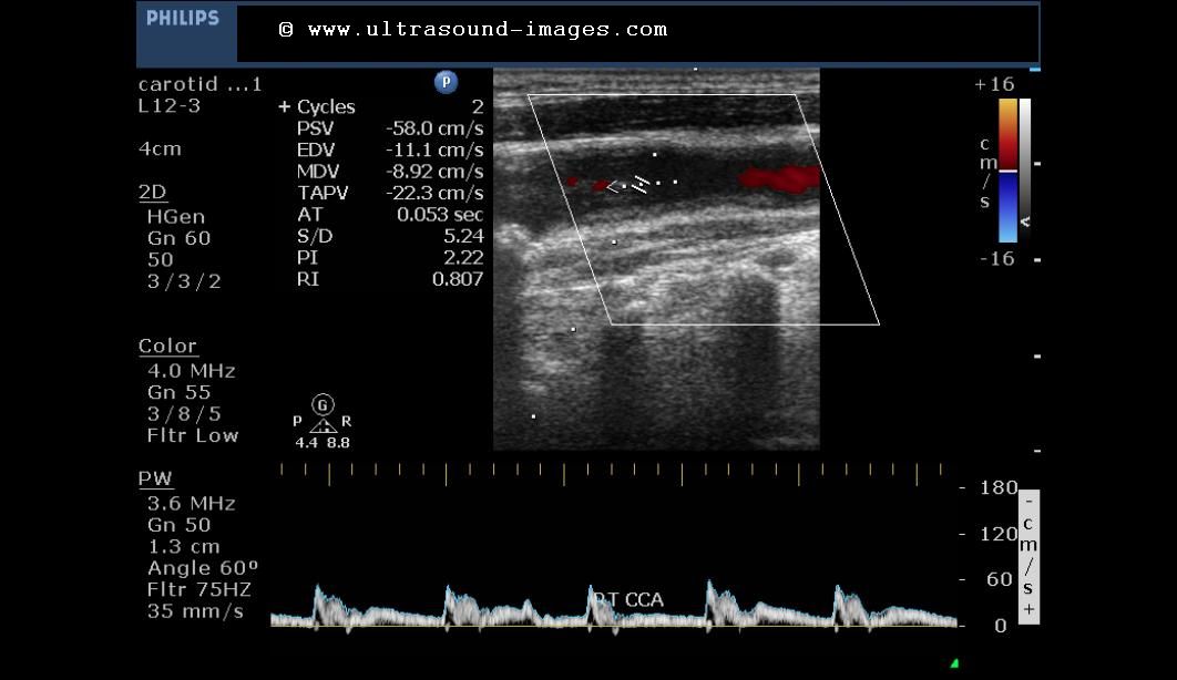 carotid doppler carotid doppler