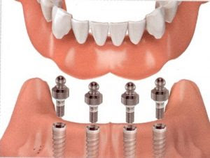 Trồng răng sứ Implant lại có giá thành cao
