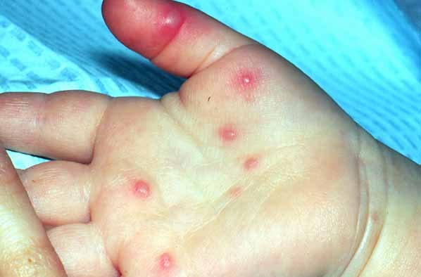 Hand, foot, and mouth disease in toddlers - BabyCenter