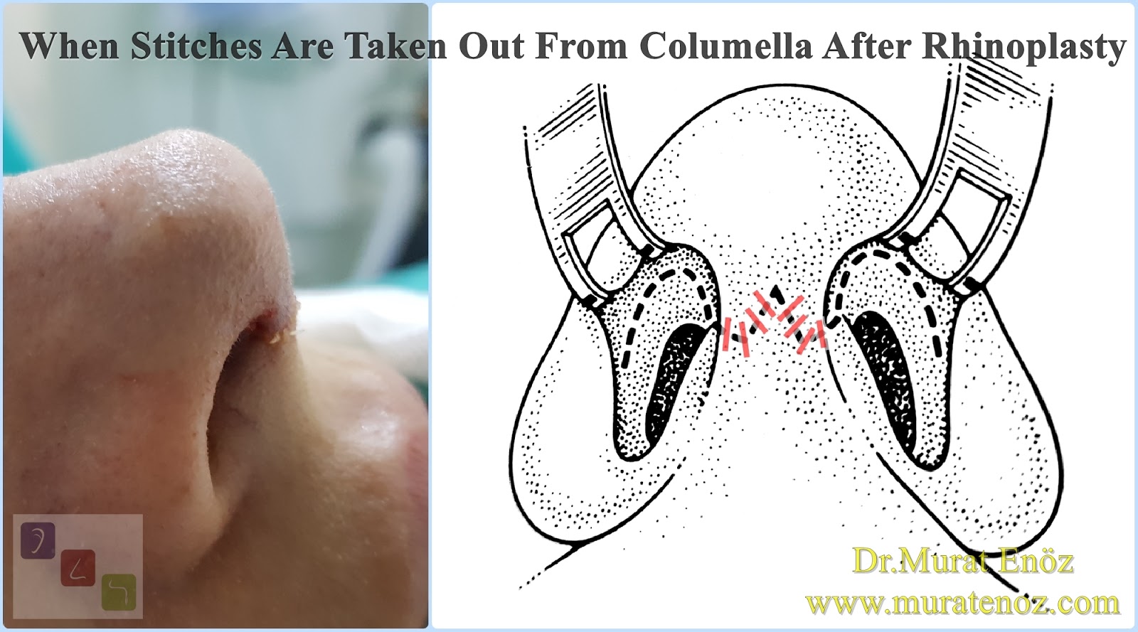 Rhinoplasty Recovery Guide 👃 45 When Stitches Are Taken Out From