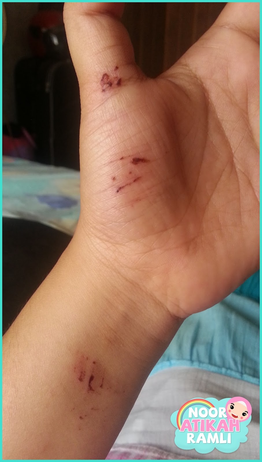 Jatuh Dari Motor Luka - Homecare24