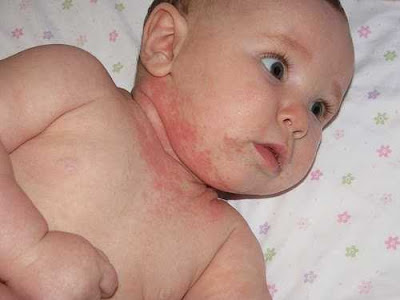Bệnh chàm da ở trẻ em - Nguyên nhân và cách điều trị  1