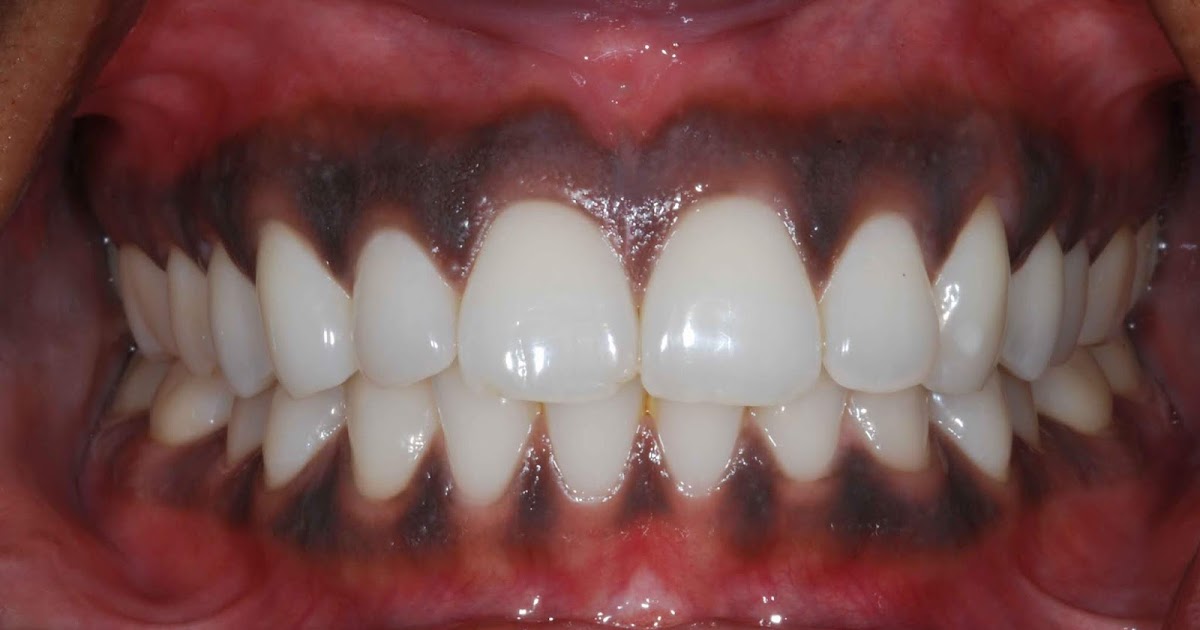 Why Is My Gum Purple Around Tooth Oris Dental Centre: Gum Bleaching – What it is and What will you get