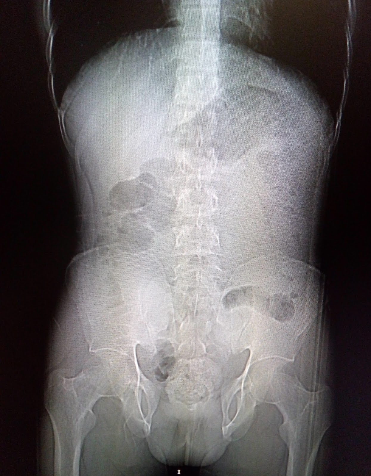 Bladder exstrophy CT Sumer's Radiology Blog