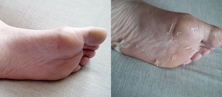 Magic Foot Peel, sexowne stopy, skarpetki złuszczające, kuracja do stóp, Skinlite, Exfoliating Foot Mask, ciało 