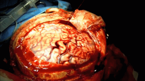 뇌출혈 환자 수술장면.gif (혐오주의) | 인스티즈