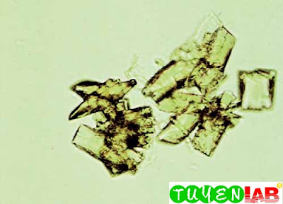 Uric acid crystals, atypical form (400 )