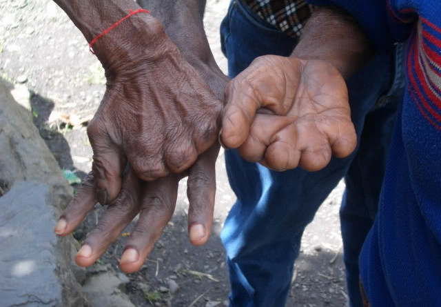  indonesian-dani-tribe-who-cut-own-finger-to-show-grief