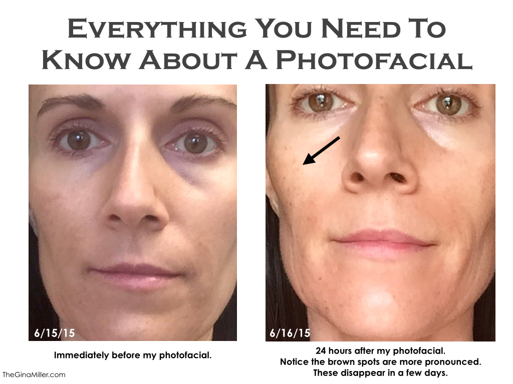 Photofacial review, photofacial before & after, photofacial cost, photofacial benefits