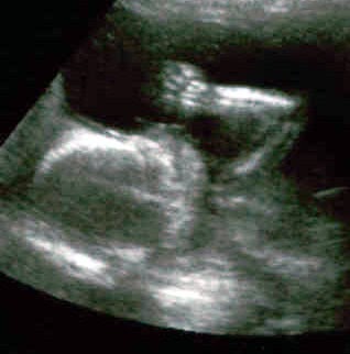 18 недель мальчик. УЗИ 18 недель беременности. Фото УЗИ 18 недель беременности.