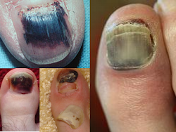 nail cancer toenail toenails fungus signs melanoma fingernail warning stages toe foot fungal stripe treatment dark causes remedies removal fingertips