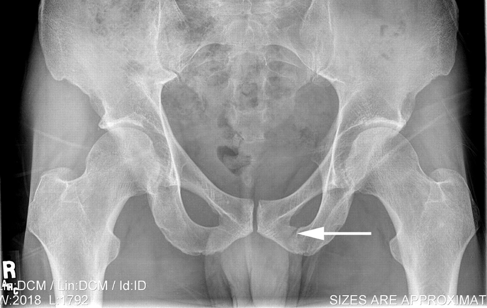 Односторонний разрыв. Перелом таза лонной кости рентген. Перелом лобковой кости таза рентген. Синовит тазобедренного сустава рентген. Перелом седалищной кости рентген.