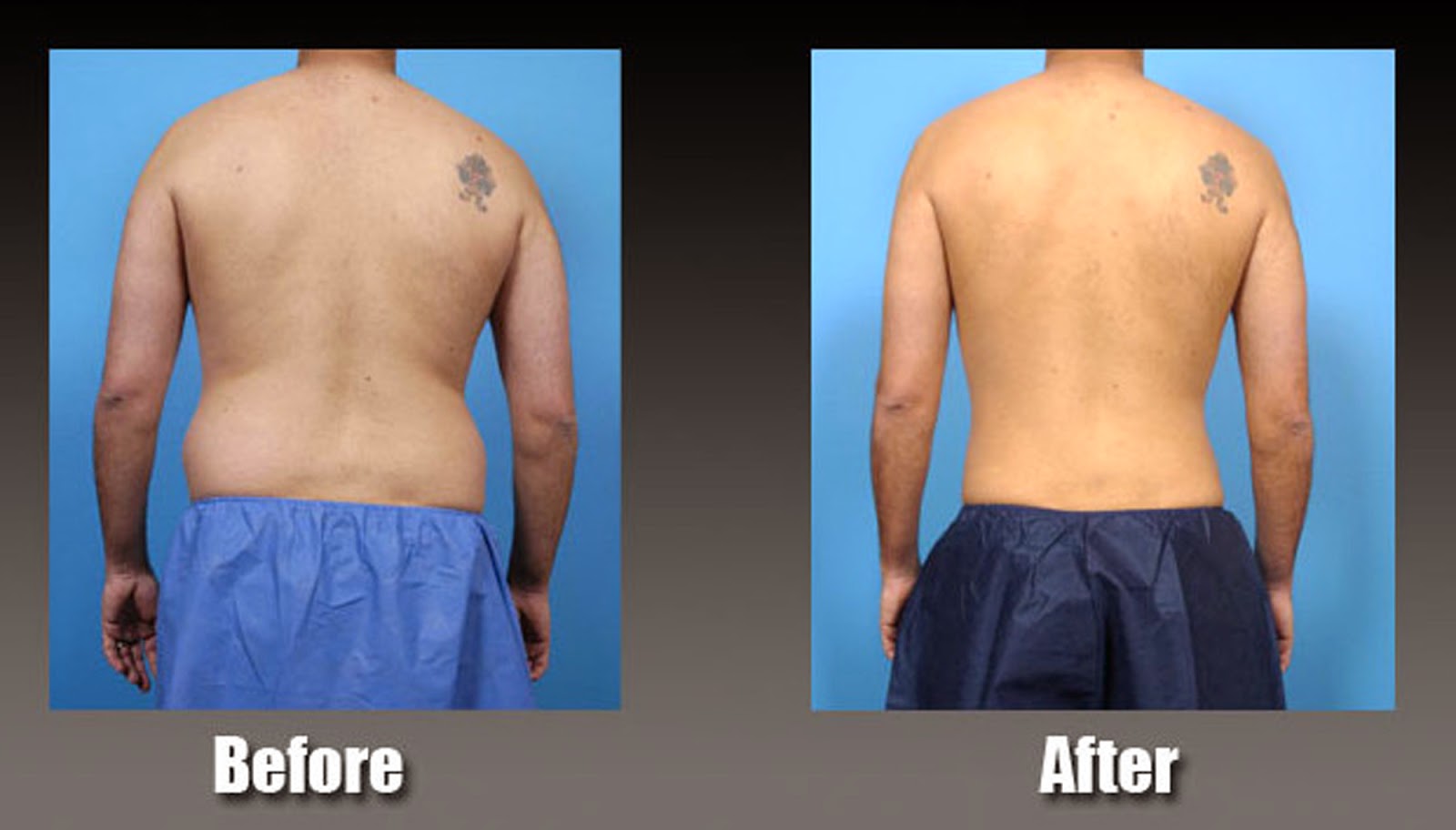 Liposuction Las Vegas