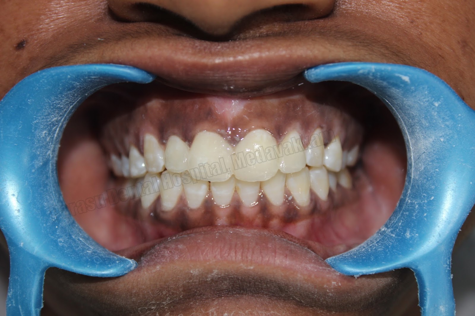 all on 4 implants in chennai midline diastema closure with composite