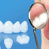 Độ bền của răng sứ cercon