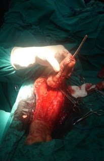 Penis Reconstruction Surgery 75
