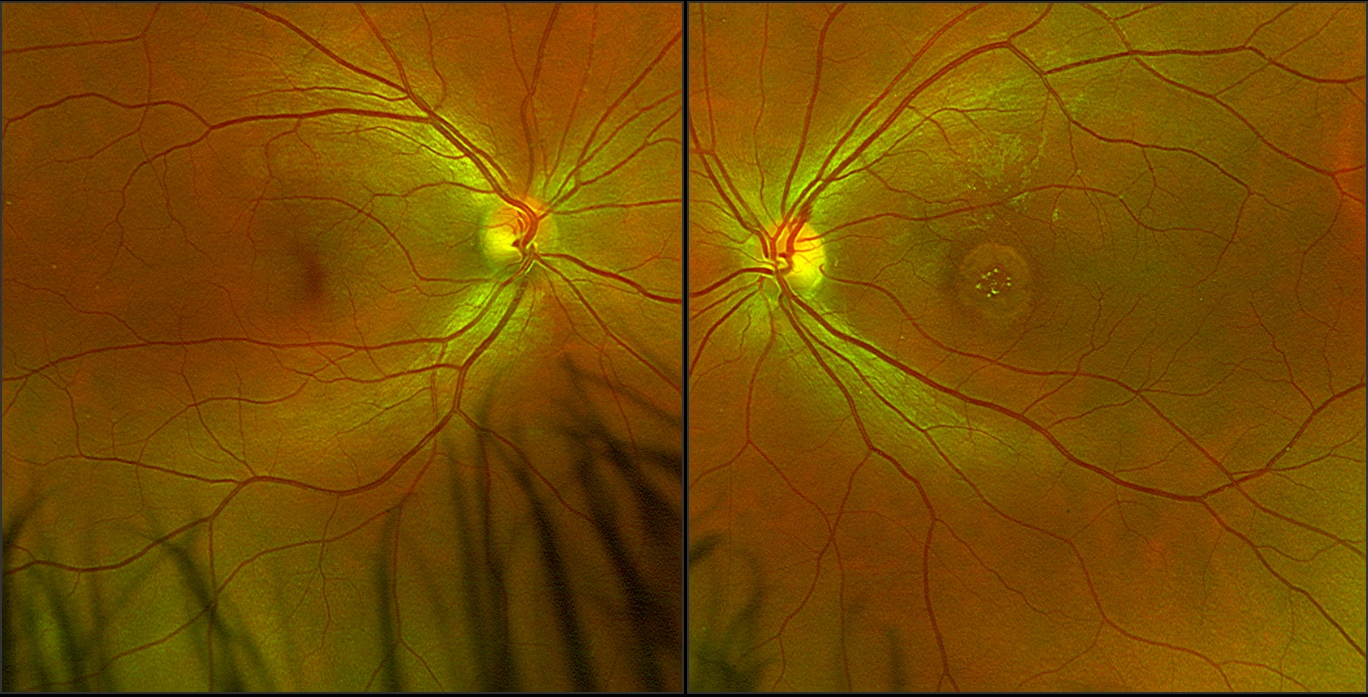 LONGSTANDING MACULAR HOLE Sonoran Desert Eye Center