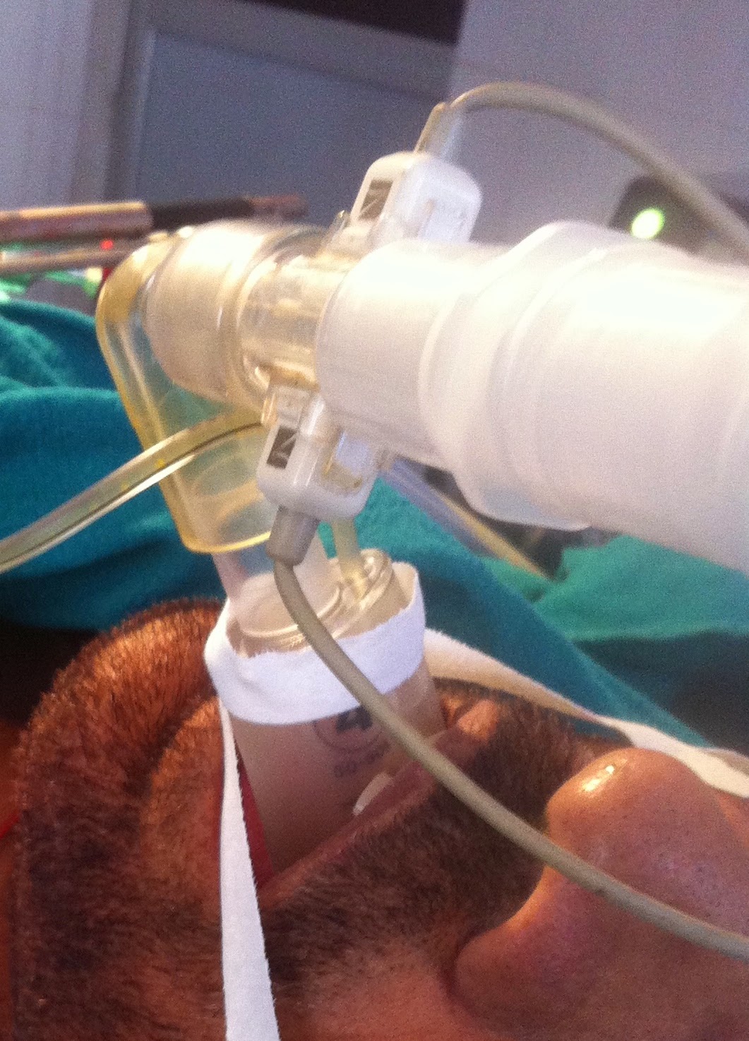 LMA for anaesthesia in routine surgeries Laryngeal Mask Airway or