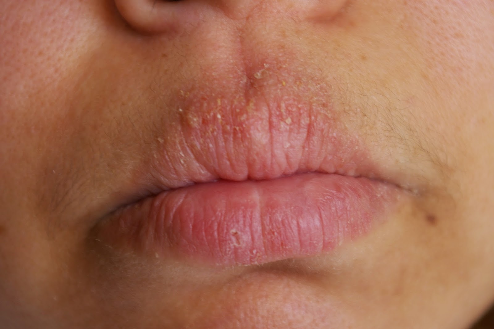 nucerity-pictures-eczema