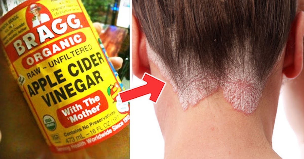 Apple Cider Vinegar Dandruff Treatment
