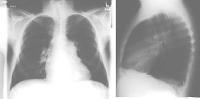 Pulmonary Heart disease Kor Pulmonal Cor Pulmonale anteroposterior lateral chest Thorax photo radiology