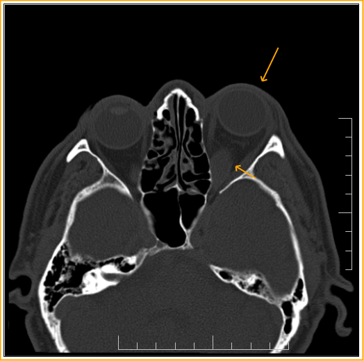 Possible Thyroid ophthalmopathyCT Sumer's Radiology Blog