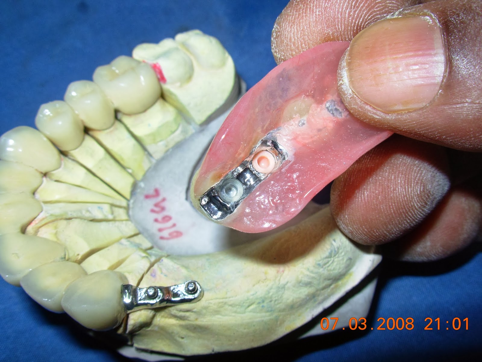P.K. Dental Clinic CASE Precision attachment RPD
