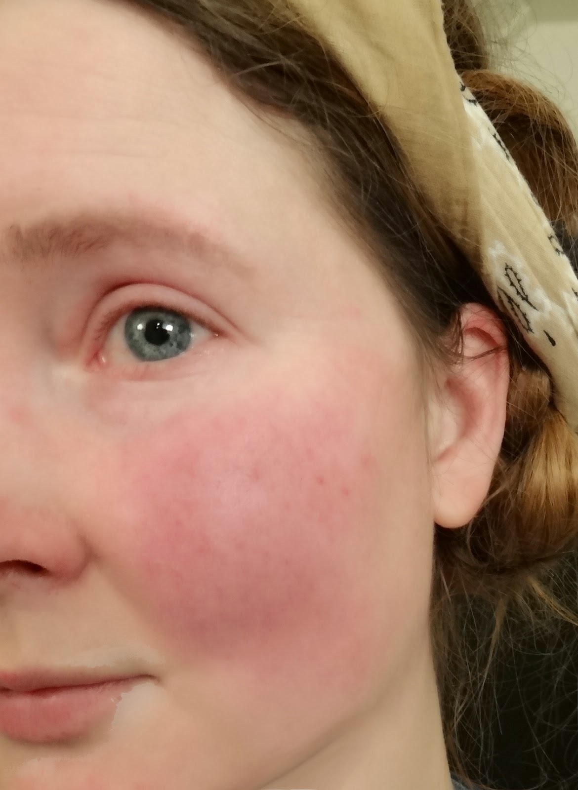 Scarlet Letters, dealing with vascular rosacea, face flushing, burning