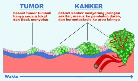 Cara Menghilangkan Benjolan Tumor Secara Alami Sampai Tuntas Cara Menghilangkan Benjolan Tumor Secara Alami Sampai Tuntas