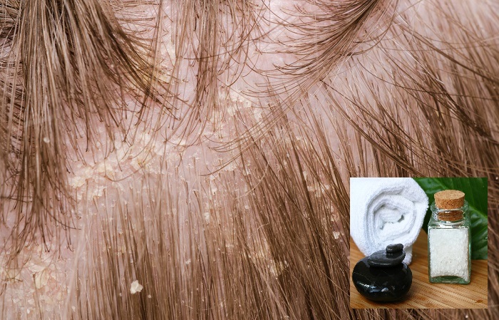comment éliminer les pellicules dans les cheveux comment éliminer les pellicules dans les cheveux