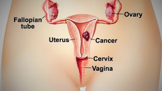 Endometrium Kanseri