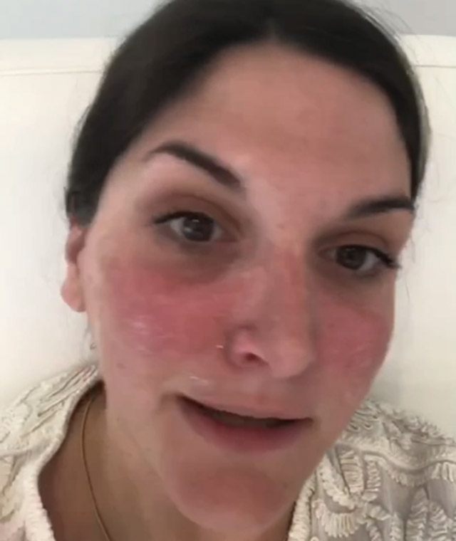 Review (with pictures) Excel V Laser for rosacea treatment and facial