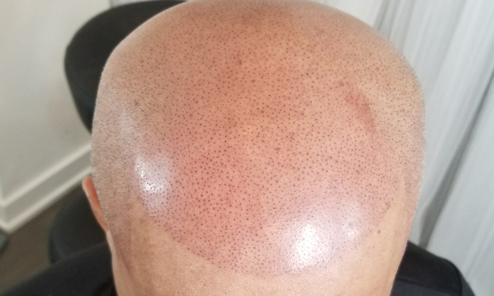 Scalp Micropigmentation Toronto